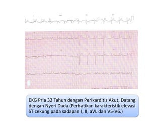 EKG Pria 32 Tahun dengan Perikarditis Akut, Datang
dengan Nyeri Dada (Perhatikan karakteristik elevasi
ST cekung pada sadapan I, II, aVL dan V5-V6.)
 