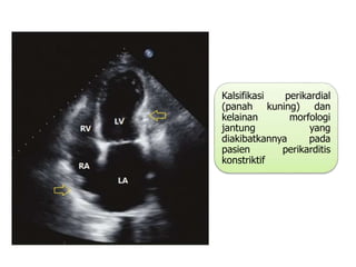 Kalsifikasi perikardial
(panah kuning) dan
kelainan morfologi
jantung yang
diakibatkannya pada
pasien perikarditis
konstriktif
 