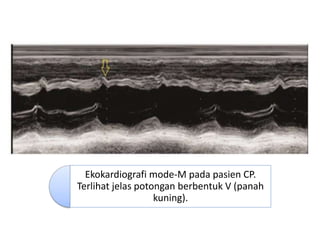 Ekokardiografi mode-M pada pasien CP.
Terlihat jelas potongan berbentuk V (panah
kuning).
 