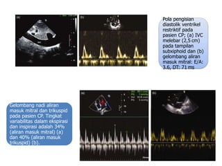 Pola pengisian
diastolik ventrikel
restriktif pada
pasien CP; (a) IVC
melebar (2,5 cm)
pada tampilan
subxiphoid dan (b)
gelombang aliran
masuk mitral: E/A:
3.6, DT: 71 ms
Gelombang nadi aliran
masuk mitral dan trikuspid
pada pasien CP. Tingkat
variabilitas dalam ekspirasi
dan inspirasi adalah 34%
(aliran masuk mitral) (a)
dan 40% (aliran masuk
trikuspid) (b).
 