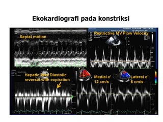 Ekokardiografi pada konstriksi
 