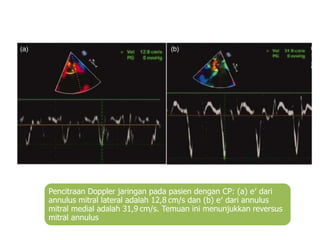Pencitraan Doppler jaringan pada pasien dengan CP: (a) e′ dari
annulus mitral lateral adalah 12,8 cm/s dan (b) e′ dari annulus
mitral medial adalah 31,9 cm/s. Temuan ini menunjukkan reversus
mitral annulus
 