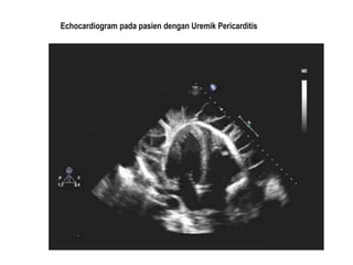 Echocardiogram pada pasien dengan Uremik Pericarditis
 
