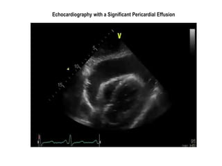 Echocardiography with a Significant Pericardial Effusion
 