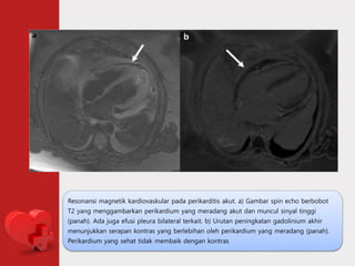 Resonansi magnetik kardiovaskular pada perikarditis akut. a) Gambar spin echo berbobot
T2 yang menggambarkan perikardium yang meradang akut dan muncul sinyal tinggi
(panah). Ada juga efusi pleura bilateral terkait. b) Urutan peningkatan gadolinium akhir
menunjukkan serapan kontras yang berlebihan oleh perikardium yang meradang (panah).
Perikardium yang sehat tidak membaik dengan kontras
 