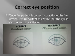 Correct eye position
 Once the patient is correctly positioned in the
device, it is important to ensure that the eye is
also correctly positioned

 