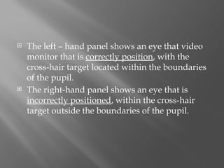  The left – hand panel shows an eye that video
monitor that is correctly position, with the
cross-hair target located within the boundaries
of the pupil.
 The right-hand panel shows an eye that is
incorrectly positioned, within the cross-hair
target outside the boundaries of the pupil.
 
