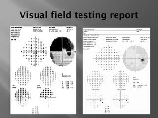 Visual field testing report
 