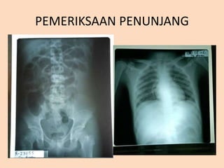 PEMERIKSAAN PENUNJANG
 