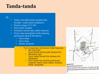 Tanda-tanda
PE :
• Tanda vital tidak terlalu berubah (bila
berubah : tanda-tanda komplikasi)
• Demam ringan (37,5-38)
• Posisi tidur, berjalan
• Peristalsis normal atau sedikit menurun
• Nyeri yang menunjukan tanda rangsang
peritoneum lokal di Mc.Burney
• Nyeri tekan
• Nyeri lepas
• Defans muskuler
• Nyeri rangsangan peritoneum tidak langsung
• Rovsing sign:
Nyeri kanan bawah pada tekanan kiri
• Blumberg sign:
Nyeri kanan bawah bila tekanan kiri
dilepaskan
• Nyeri kanan bawah bila peritoneum
bergerak seperti nafas dalam, berjalan,
batuk, mengedan
 