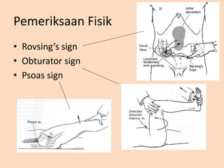 Pemeriksaan Fisik
• Rovsing’s sign
• Obturator sign
• Psoas sign
 