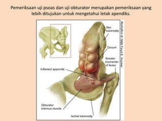 Pemeriksaan uji psoas dan uji obturator merupakan pemeriksaan yang
lebih ditujukan untuk mengetahui letak apendiks.
 