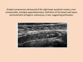 Graded compression ultrasound of the right lower quadrant reveals a non-
compressible, enlarged appendix(arrows). Definition of the bowel wall layers,
particularlythe echogenic submucosa, is lost, suggesting perforation.
 