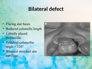 Flaring Ridge Defect Comprehensive Guide to Pre-Surgical Naso-Alveolar Molding for Cleft Lip ...