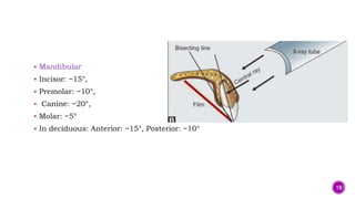  Mandibular
 Incisor: −15°,
 Premolar: −10°,
 Canine: −20°,
 Molar: −5°
 In deciduous: Anterior: −15°, Posterior: −10°
19
 