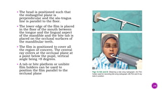  The head is positioned such that
the midsagittal plane is
perpendicular and the ala-tragus
line is parallel to the floor.
 The lower edge of the film is placed
in the floor of the mouth between
the tongue and the lingual aspect
of the mandible and the bite tab is
placed on the occlusal surfaces of
the mandibular teeth.
 The film is positioned to cover all
the region of concern. The central
ray enters at the occlusal plane at
a point below the pupil, vertical
angle being +8 degrees.
 A tab or bite platform or unibite
film holders can be used to
position the film parallel to the
occlusal plane
24
 