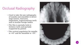 Occlusal Radiography
 Used to take the jaw radiographs
of maxilla and mandible to detect
large lesions, fractures,
impactions, supernumerary teeth
and to localize foreign bodies
 The film is partially held in
between teeth and partially
supported by patient
 The vertical angulation for maxilla
is +45° and for mandible is −55°.
25
 