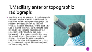  Maxillary anterior topographic radiograph is
indicated to view anterior maxilla and its
dentition. While taking the radiograph the
patient’s head is adjusted so that the
occlusal plane is horizontal to the floor. The
film is placed crosswise in the mouth with
exposure side towards maxilla and the
posterior border touching the rami
horizontally. The patient is asked to close
the mouth gently. Central ray is directed
through the tip of the nose toward the
middle of the film with approximately +45
degrees vertical angulation and 0 degrees
horizontal angulation
28
 