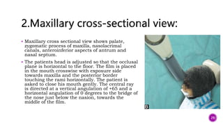  Maxillary cross sectional view shows palate,
zygomatic process of maxilla, nasolacrimal
canals, anteroinferior aspects of antrum and
nasal septum.
 The patients head is adjusted so that the occlusal
plane is horizontal to the floor. The film is placed
in the mouth crosswise with exposure side
towards maxilla and the posterior border
touching the rami horizontally. The patient is
asked to close his mouth gently. The central ray
is directed at a vertical angulation of +65 and a
horizontal angulation of 0 degrees to the bridge of
the nose just below the nasion, towards the
middle of the film.
29
 