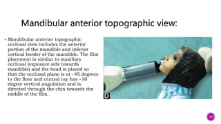  Mandibular anterior topographic
occlusal view includes the anterior
portion of the mandible and inferior
cortical border of the mandible. The film
placement is similar to maxillary
occlusal (exposure side towards
mandible) and the head is placed so
that the occlusal plane is at –45 degrees
to the floor and central ray has –10
degree vertical angulation and is
directed through the chin towards the
middle of the film.
31
 
