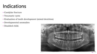  Condylar fracture
 Traumatic cysts
 Evaluation of tooth development (mixed dentition)
 Developmental anomalies
 Disabled child.
37
 