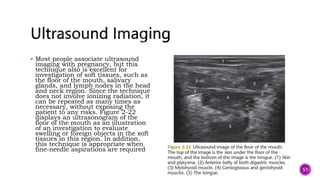  Most people associate ultrasound
imaging with pregnancy, but this
technique also is excellent for
investigation of soft tissues, such as
the floor of the mouth, salivary
glands, and lymph nodes in the head
and neck region. Since the technique
does not involve ionizing radiation, it
can be repeated as many times as
necessary, without exposing the
patient to any risks. Figure 2-22
displays an ultrasonogram of the
floor of the mouth as an illustration
of an investigation to evaluate
swelling or foreign objects in the soft
tissues in this region. In addition,
this technique is appropriate when
fine-needle aspirations are required
51
 