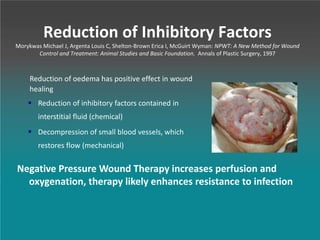 Reduction of Inhibitory Factors
Morykwas Michael J, Argenta Louis C, Shelton-Brown Erica I, McGuirt Wyman: NPWT: A New Method for Wound
Control and Treatment: Animal Studies and Basic Foundation. Annals of Plastic Surgery, 1997
Reduction of oedema has positive effect in wound
healing
 Reduction of inhibitory factors contained in
interstitial fluid (chemical)
 Decompression of small blood vessels, which
restores flow (mechanical)
Negative Pressure Wound Therapy increases perfusion and
oxygenation, therapy likely enhances resistance to infection
 