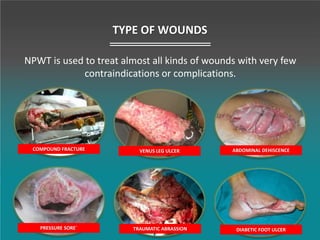 COMPOUND FRACTURE
TRAUMATIC ABRASSIONPRESSURE SORE`
VENUS LEG ULCER
DIABETIC FOOT ULCER
ABDOMINAL DEHISCENCE
TYPE OF WOUNDS
NPWT is used to treat almost all kinds of wounds with very few
contraindications or complications.
 
