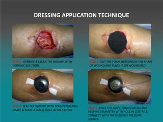 STEP 1 : DEBRIDE & CLEAN THE WOUND WITH
ISOTONIC SOLUTION
STEP 2 : CUT THE FOAM DRESSING IN THE SHAPE
OF WOUND AND PLACE IT ON WOUND BED
STEP 4 : STICK THE MAPC TUBING DISTAL END
KEEPING SYMMETRY WITH HOLE IN CENTRE &
CONNECT WITH THE NEGATIVE PRESSURE
SOURCE
STEP 3: SEAL THE WOUND WITH SEMI-PERMEABLE
DRAPE & MAKE A SMALL HOLE IN THE CENTRE
DRESSING APPLICATION TECHNIQUE
 