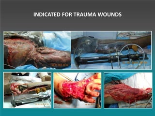 INDICATED FOR TRAUMA WOUNDS
 
