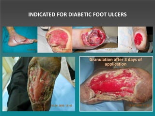 Granulation after 3 days of
application
INDICATED FOR DIABETIC FOOT ULCERS
 