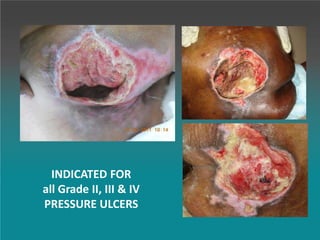 INDICATED FOR
all Grade II, III & IV
PRESSURE ULCERS
 