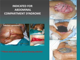 Infected Laprotomy
**Please seek advice for special Dressing selection
INDICATED FOR
ABDOMINAL
COMPARTMENT SYNDROME
 
