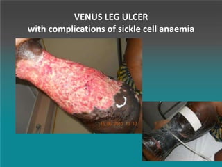 VENUS LEG ULCER
with complications of sickle cell anaemia
 