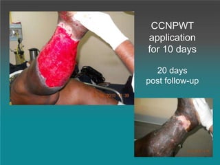 CCNPWT
application
for 10 days
20 days
post follow-up
 