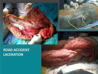 ROAD ACCIDENT
LACERATION
 