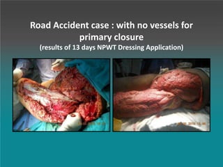 Road Accident case : with no vessels for
primary closure
(results of 13 days NPWT Dressing Application)
 
