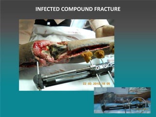 INFECTED COMPOUND FRACTURE
 