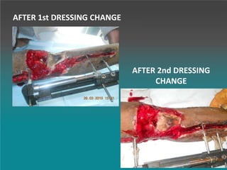 AFTER 1st DRESSING CHANGE
AFTER 2nd DRESSING
CHANGE
 