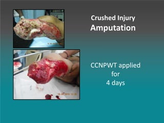 Crushed Injury
Amputation
CCNPWT applied
for
4 days
 