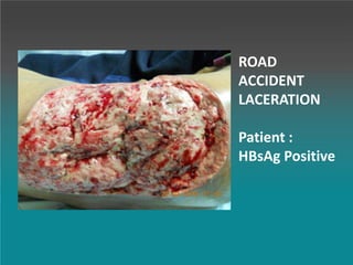 ROAD
ACCIDENT
LACERATION
Patient :
HBsAg Positive
 