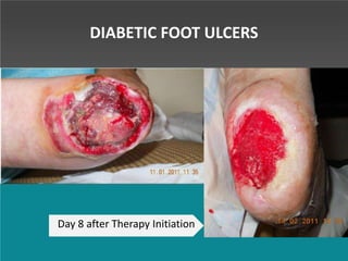 DIABETIC FOOT ULCERS
Day 8 after Therapy Initiation
 