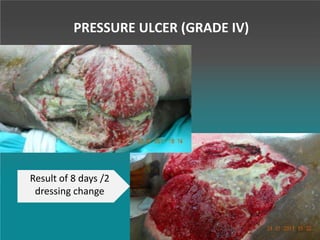 PRESSURE ULCER (GRADE IV)
Result of 8 days /2
dressing change
 