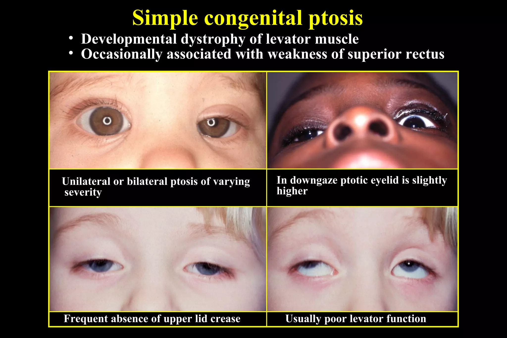 Simple congenital ptosis
• Developmental dystrophy of levator muscle
• Occasionally associated with weakness of superior rectus
Unilateral or bilateral ptosis of varying
severity
In downgaze ptotic eyelid is slightly
higher
Frequent absence of upper lid crease Usually poor levator function
 