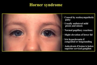 Horner syndrome
• Caused by oculosympathetic
palsy
• Usually unilateral mild
ptosis and miosis
• Slight elevation of lower lid
• Normal pupillary reactions
• Iris hypochromia if
congenital or longstanding
• Anhydrosis if lesion is below
superior cervical ganglion
 