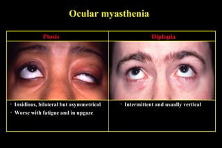 Ocular myasthenia
• Insidious, bilateral but asymmetrical
• Worse with fatigue and in upgaze
Ptosis
• Intermittent and usually vertical
Diplopia
 