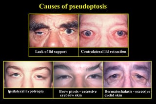Causes of pseudoptosis
Ipsilateral hypotropia Brow ptosis - excessive
eyebrow skin
Dermatochalasis - excessive
eyelid skin
Lack of lid support Contralateral lid retraction
 