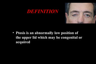 DEFINITION
• Ptosis is an abnormally low position of
the upper lid which may be congenital or
acquired
 