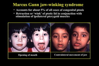 Marcus Gunn jaw-winking syndrome
• Accounts for about 5% of all cases of congenital ptosis
• Retraction or ‘wink’ of ptotic lid in conjunction with
stimulation of ipsilateral pterygoid muscles
Opening of mouth Contralateral movement of jaw
 