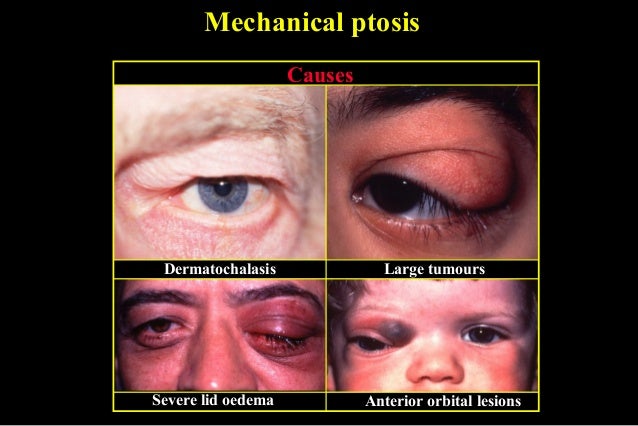 ptosis pseudoptosis dermatochalasis severe levator